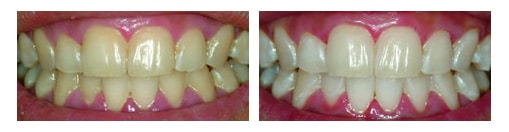 Zoom is the same whitening system featured on The Today Show, Extreme 